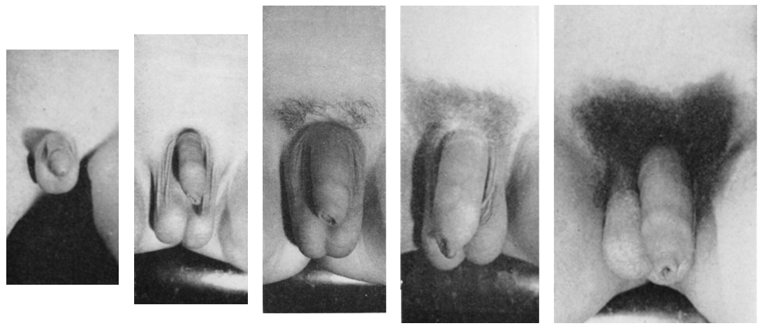 Male_genitalia_five_Tanner_stages